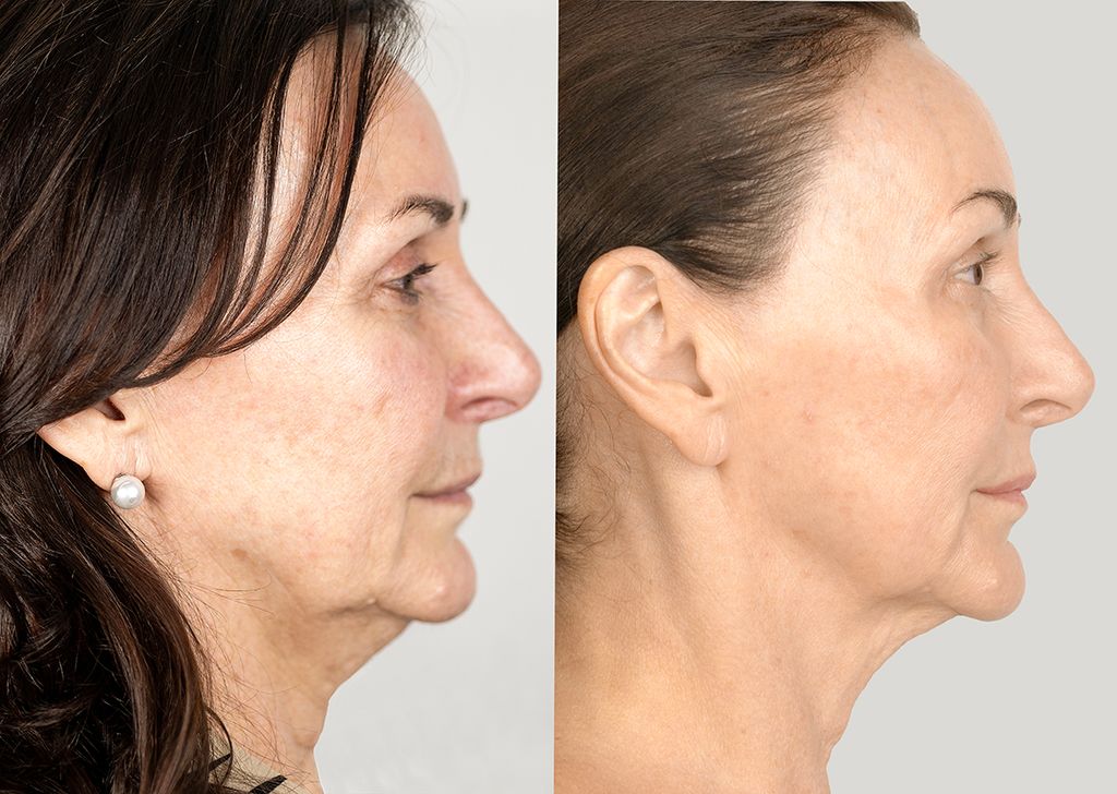 Strictly's Shirley Ballas reveals non-surgical facelift 'shaved 30 years  off' - before and after photos | HELLO!