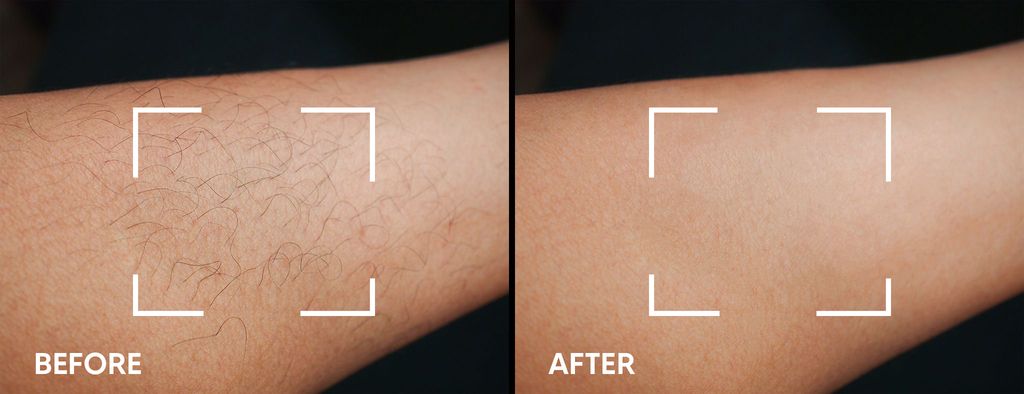 Keskine IPL device before and after hair reduction on arm