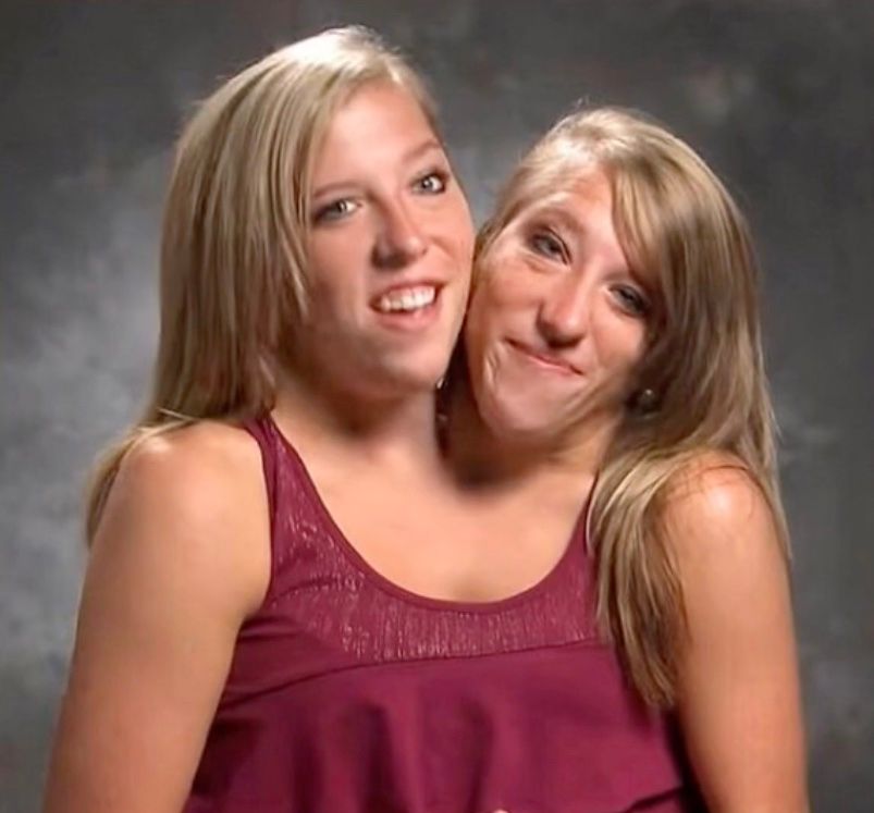 Conjoined twins Abby and Brittany Hensel break silence after surprise  wedding news | HELLO!